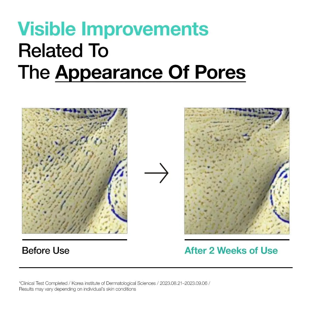 Comparison images showing visible improvements related to the appearance of pores before and after 2 weeks of using ANUA BHA 2% Gentle Exfoliating Toner 150ml