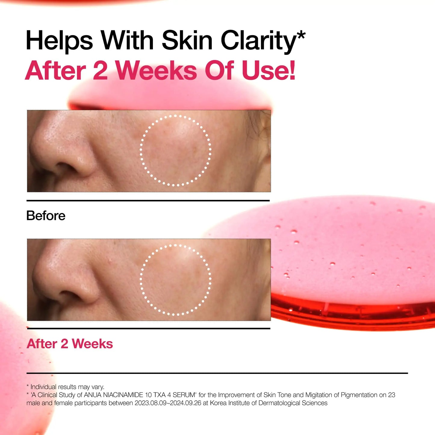 Comparison close-up images showing improved skin clarity and reduced pigmentation after two weeks of using ANUA Niacinamide 10+ TXA 4 Serum 30ml, with a pink serum applicator visible.