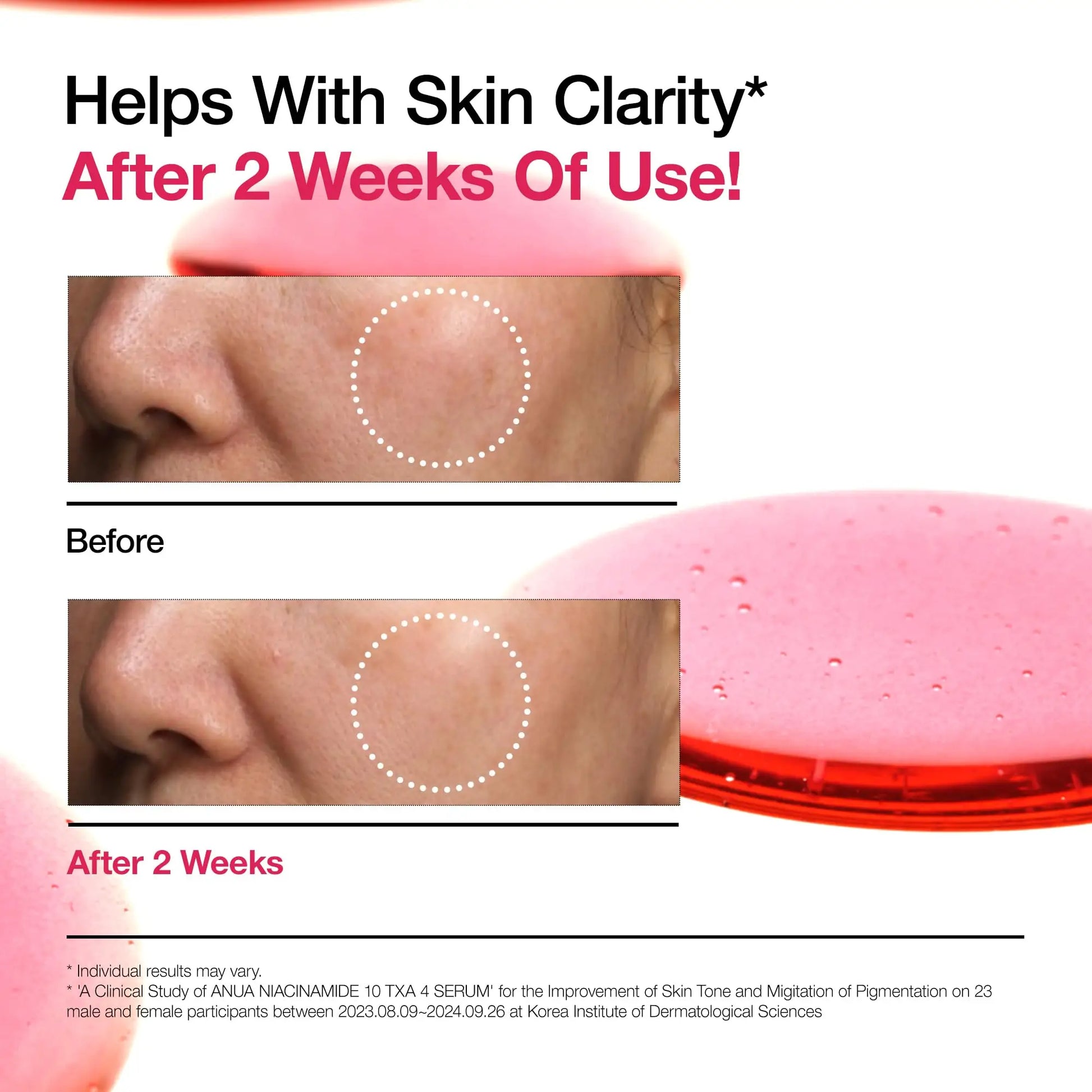 Comparison close-up images showing improved skin clarity and reduced pigmentation after two weeks of using ANUA Niacinamide 10+ TXA 4 Serum 30ml, with a pink serum applicator visible.