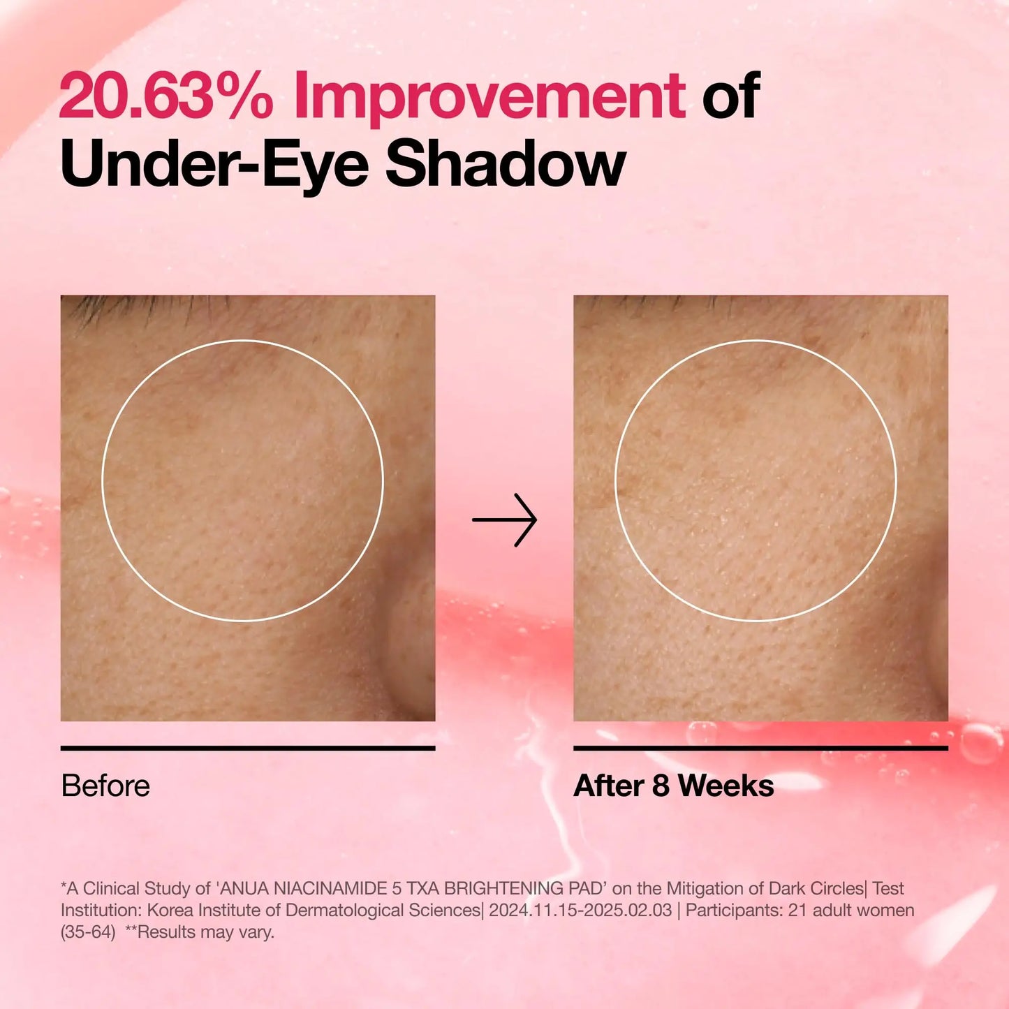 Comparison of skin under-eye area before and after using Anua Niacinamide 5 TXA Brightening Pads 210ml for 8 weeks, showing 20.63 percent improvement in under-eye shadow reduction.