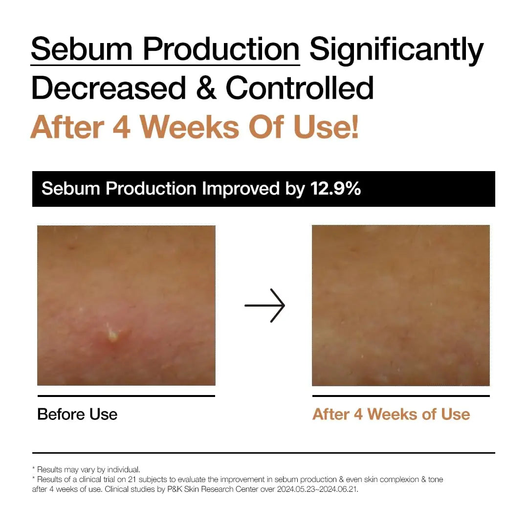 Before and after close-up photos of skin showing reduced sebum production and clearer complexion after 4 weeks of using Anua rice 70 glow milky toner 250ml, highlighting a 12.9% improvement.