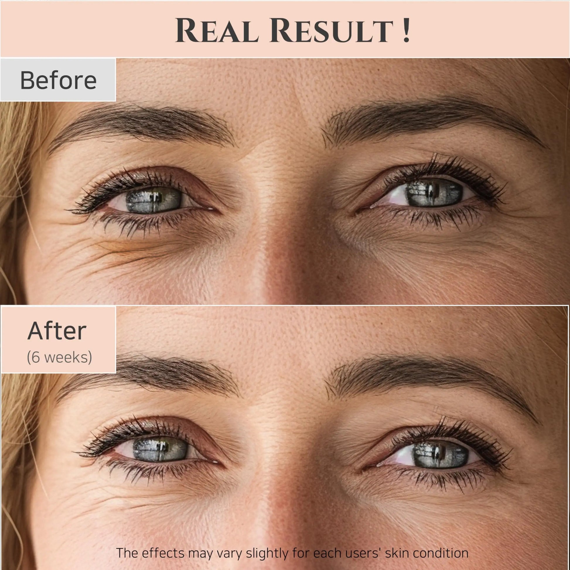 Before and after comparison showing reduced wrinkles and improved skin texture around the eyes after six weeks of using Beauty of Joseon Revive Eye Serum Ginseng and Retinal Niacinamide 30ml.