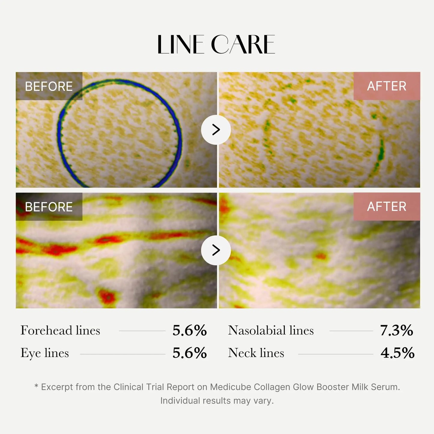 Before and after microscopic close-up images showing reduction in forehead lines, eye lines, nasolabial lines, and neck lines after using medicube Collagen Glow Booster Serum 15ml.