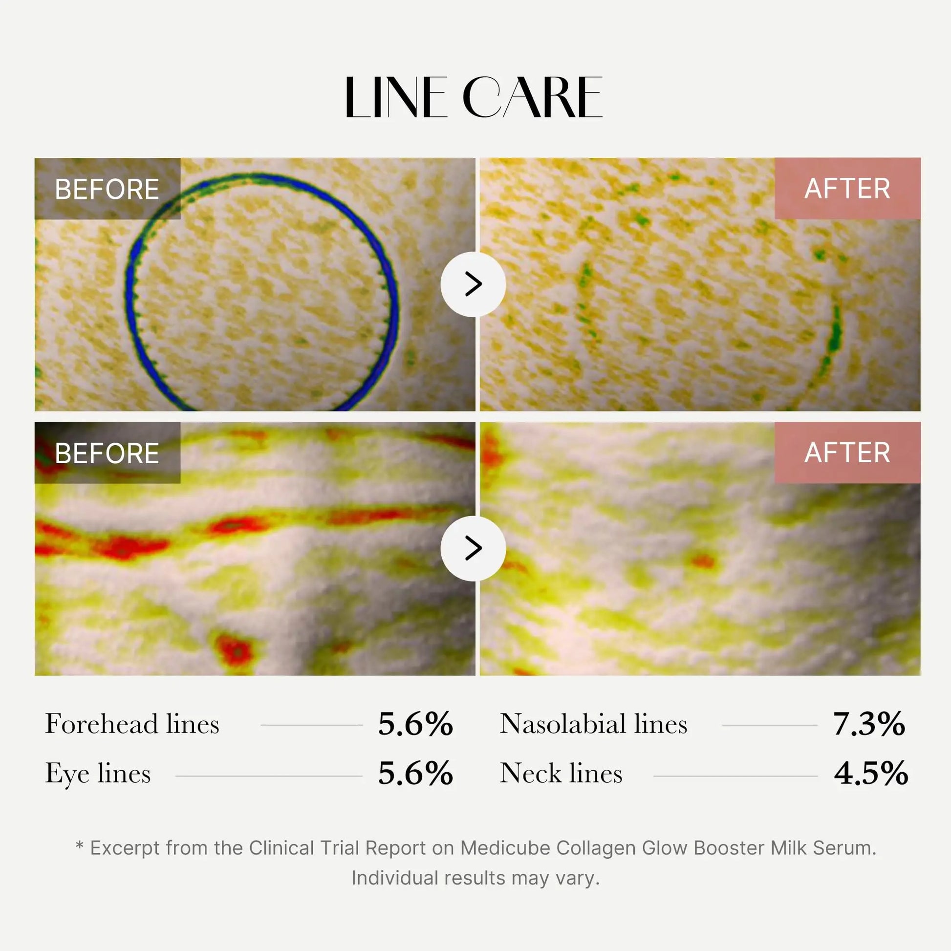 Before and after microscopic close-up images showing reduction in forehead lines, eye lines, nasolabial lines, and neck lines after using medicube Collagen Glow Booster Serum 15ml.