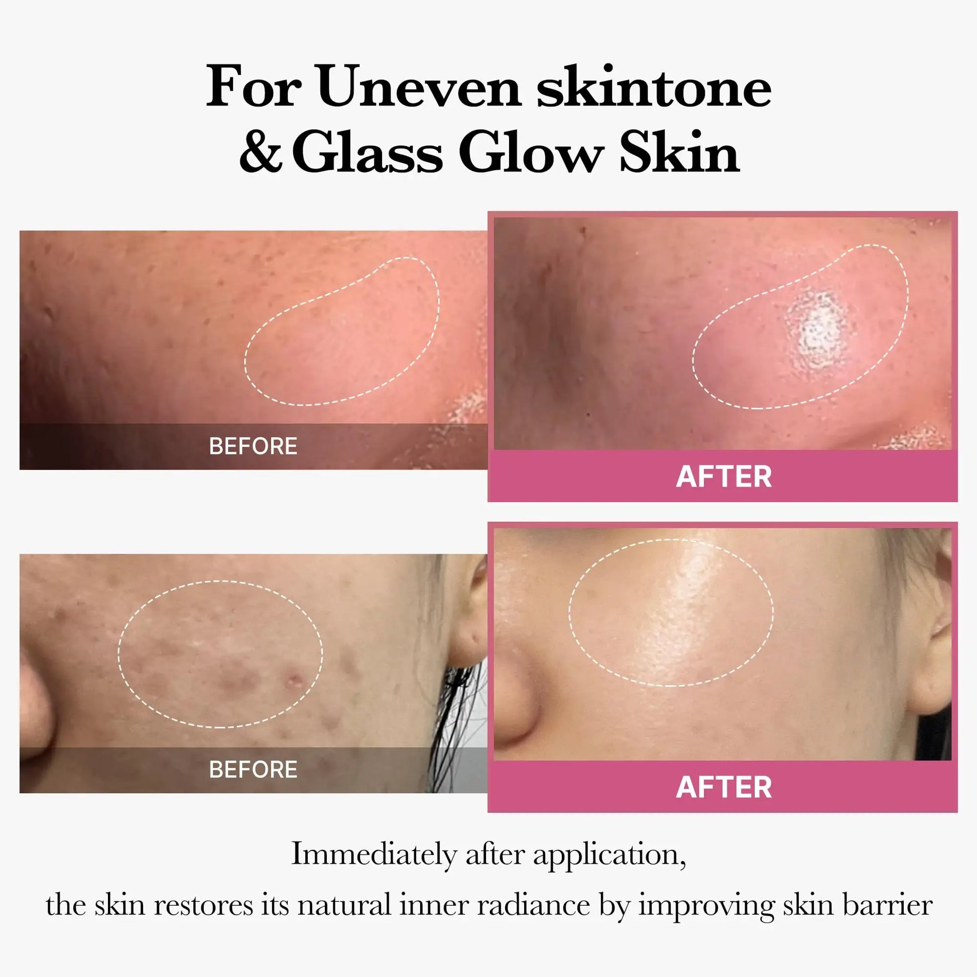 Before and after close-up photos demonstrating the effects of medicube Collagen Jelly Cream 50ml on uneven skin tone and enhancing glass glow skin, showing improved radiance and skin barrier.