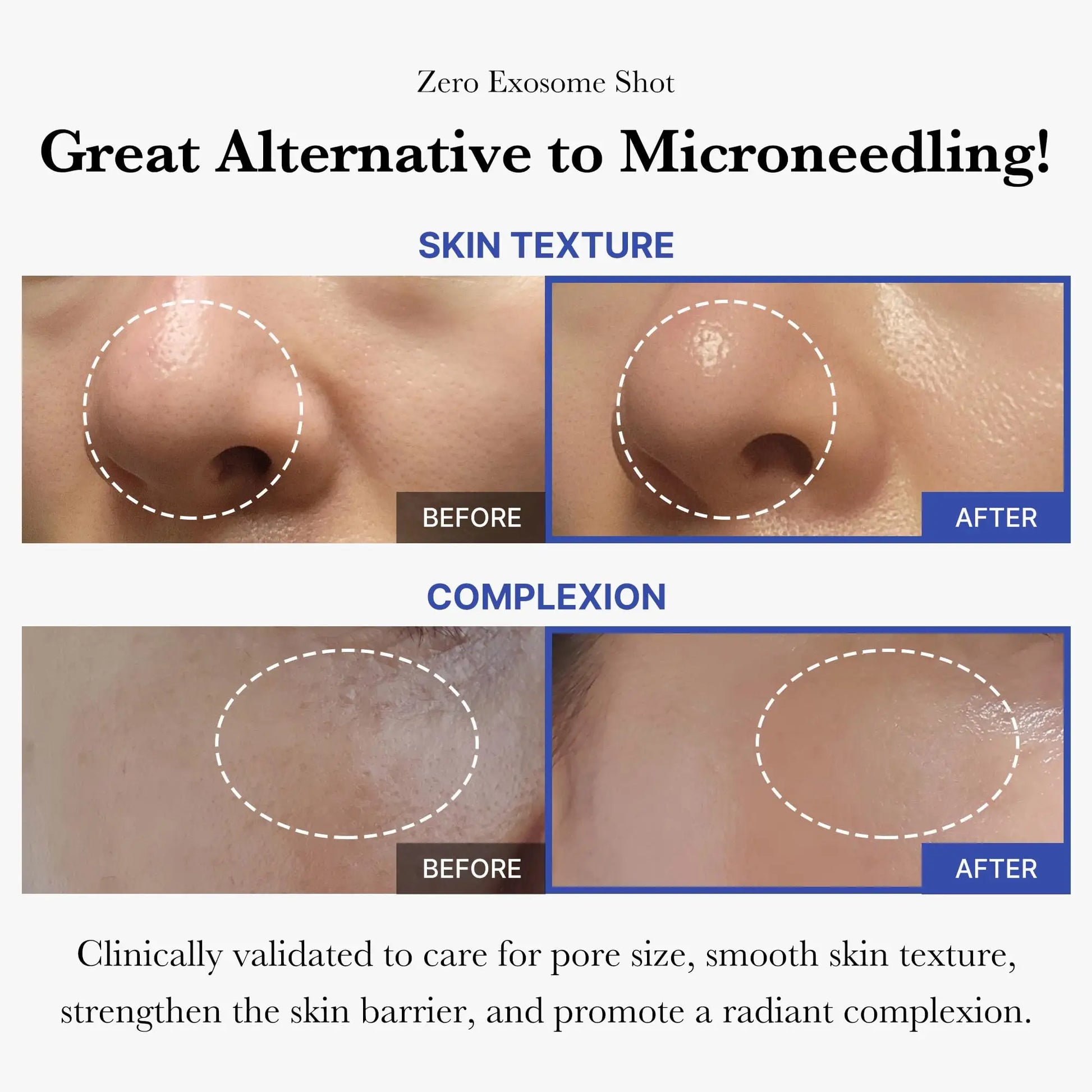 Before and after close-up images show improved skin texture and radiant complexion, highlighting the benefits of medicube Oneday Exosome Shot 7500 30ml + Medicube Collagen Jelly Cream 50ml as an alternative to microneedling.