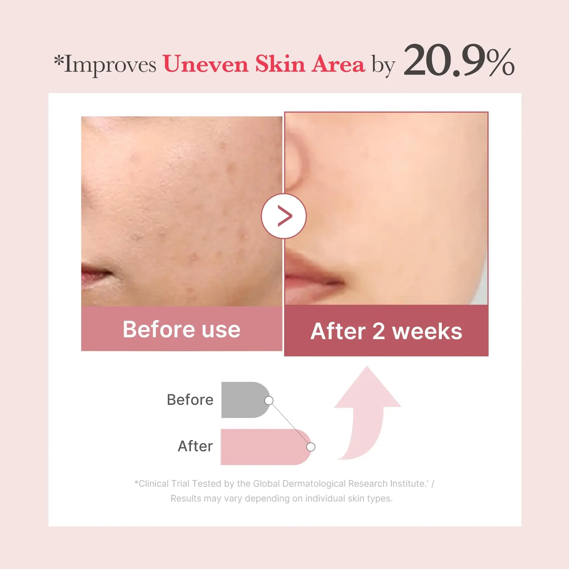 Comparison of skin texture showing visible improvement in uneven skin area after two weeks of using medicube PDRN Pink Collagen Exosome Shot 7500 30ml with before and after photos and clinical trial results.