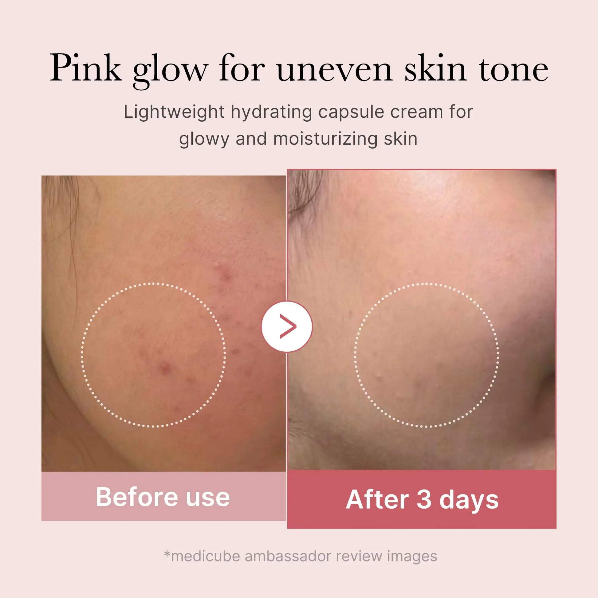 Comparison of skin before and after using medicube PDRN Pink Peptide Serum 30ml + PDRN Pink Collagen Capsule Cream 55g, showing reduced redness and more even skin tone after 3 days.