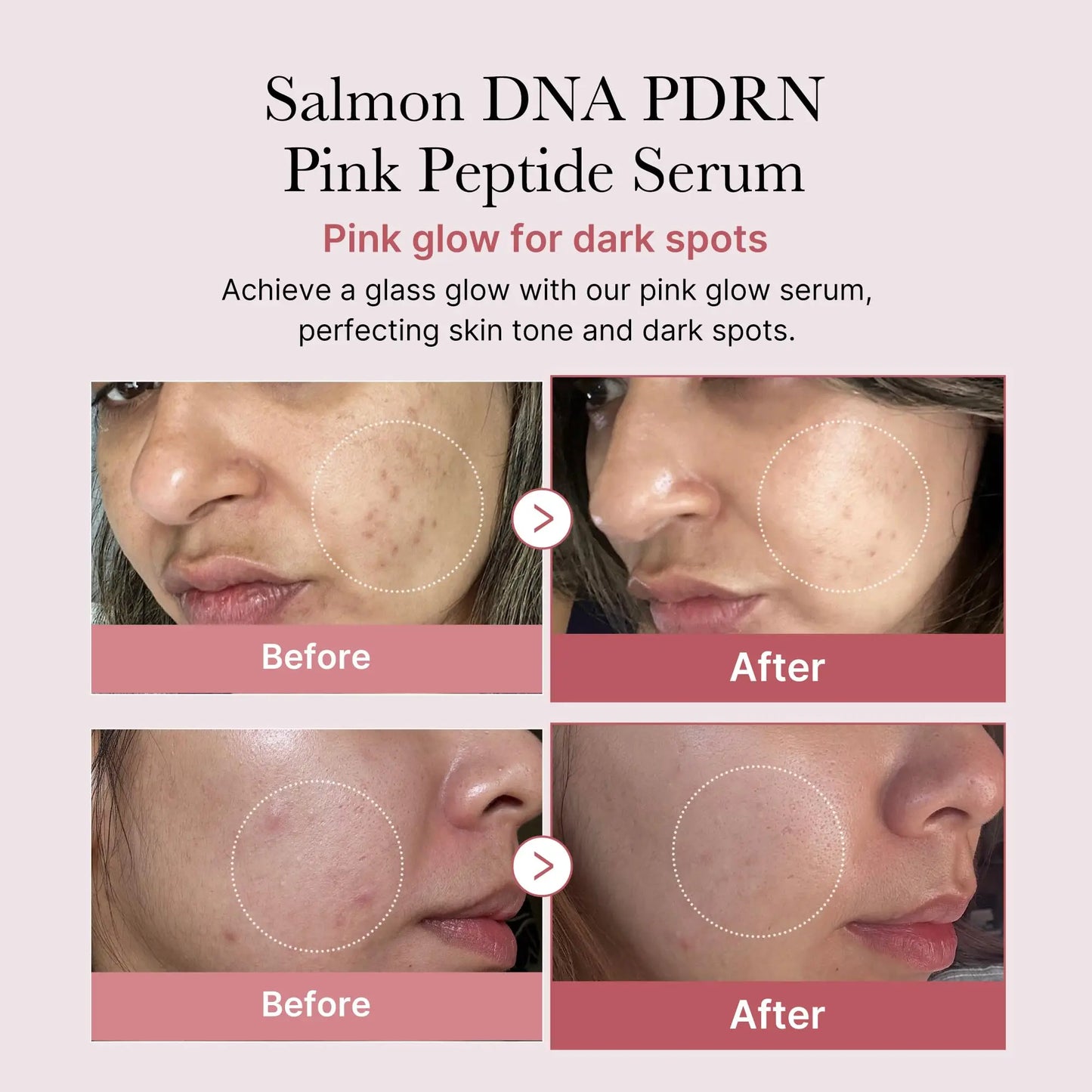 Before and after images showing improved skin tone and reduced dark spots on cheeks using medicube PDRN Pink Peptide Serum 30ml + PDRN Pink Collagen Capsule Cream 55g for a radiant glow
