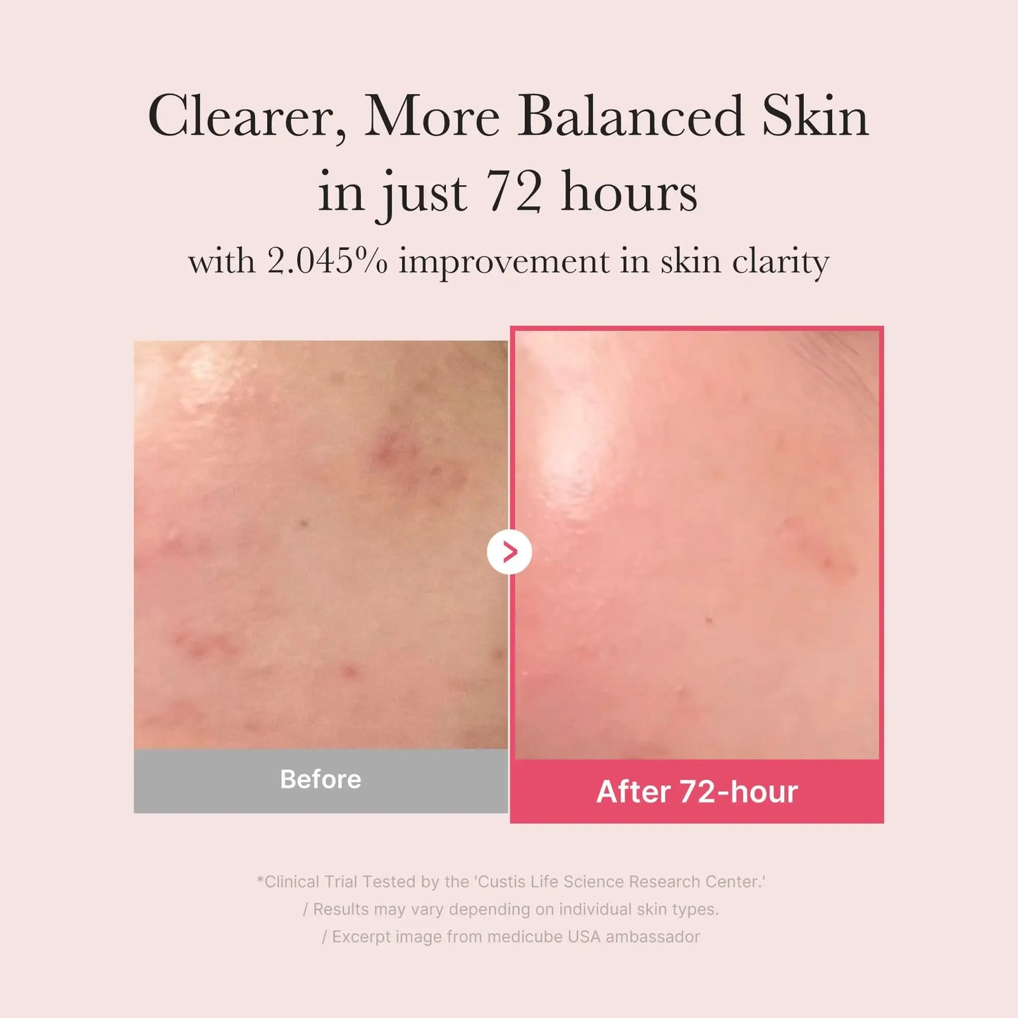 Before and after comparison showing clearer, more balanced skin in 72 hours with medicube TXA Niacinamide 15 Serum 30ml, highlighting improved skin clarity and reduced redness.