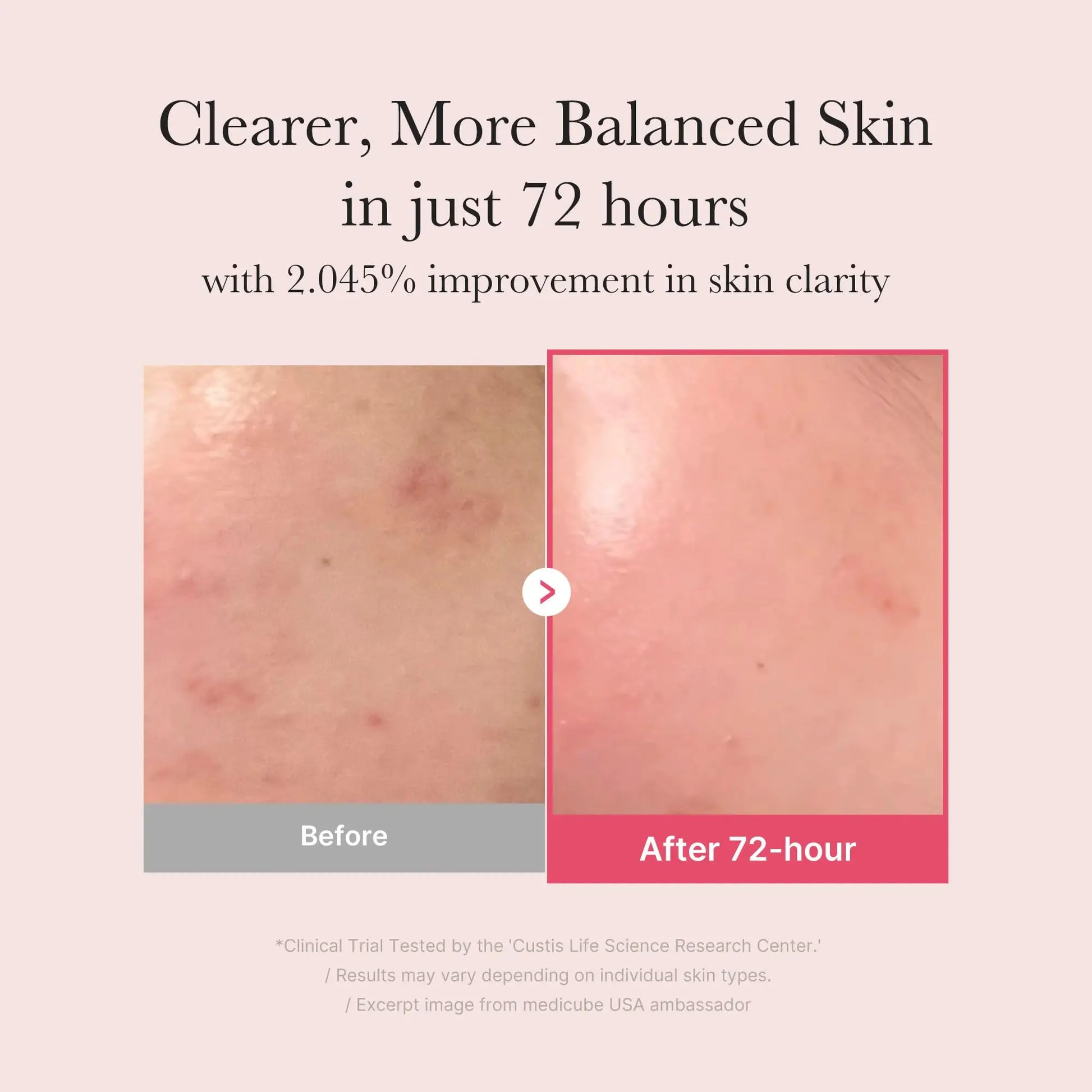 Before and after comparison showing clearer, more balanced skin in 72 hours with medicube TXA Niacinamide 15 Serum 30ml, highlighting improved skin clarity and reduced redness.