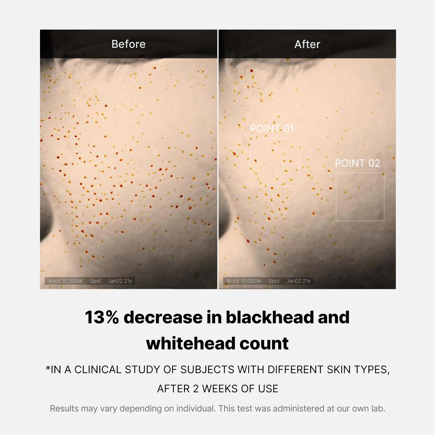 Comparison image showing before and after results of using medicube Zero Pore Oneday Serum 30ml with a 13% decrease in blackhead and whitehead count after two weeks of use on facial skin