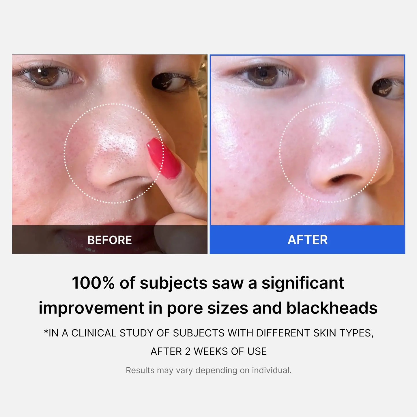 Before and after close-up photos of a nose showing reduced pore size and blackheads, demonstrating the effectiveness of medicube Zero Pore Pads 155g 70pcs after two weeks of use.