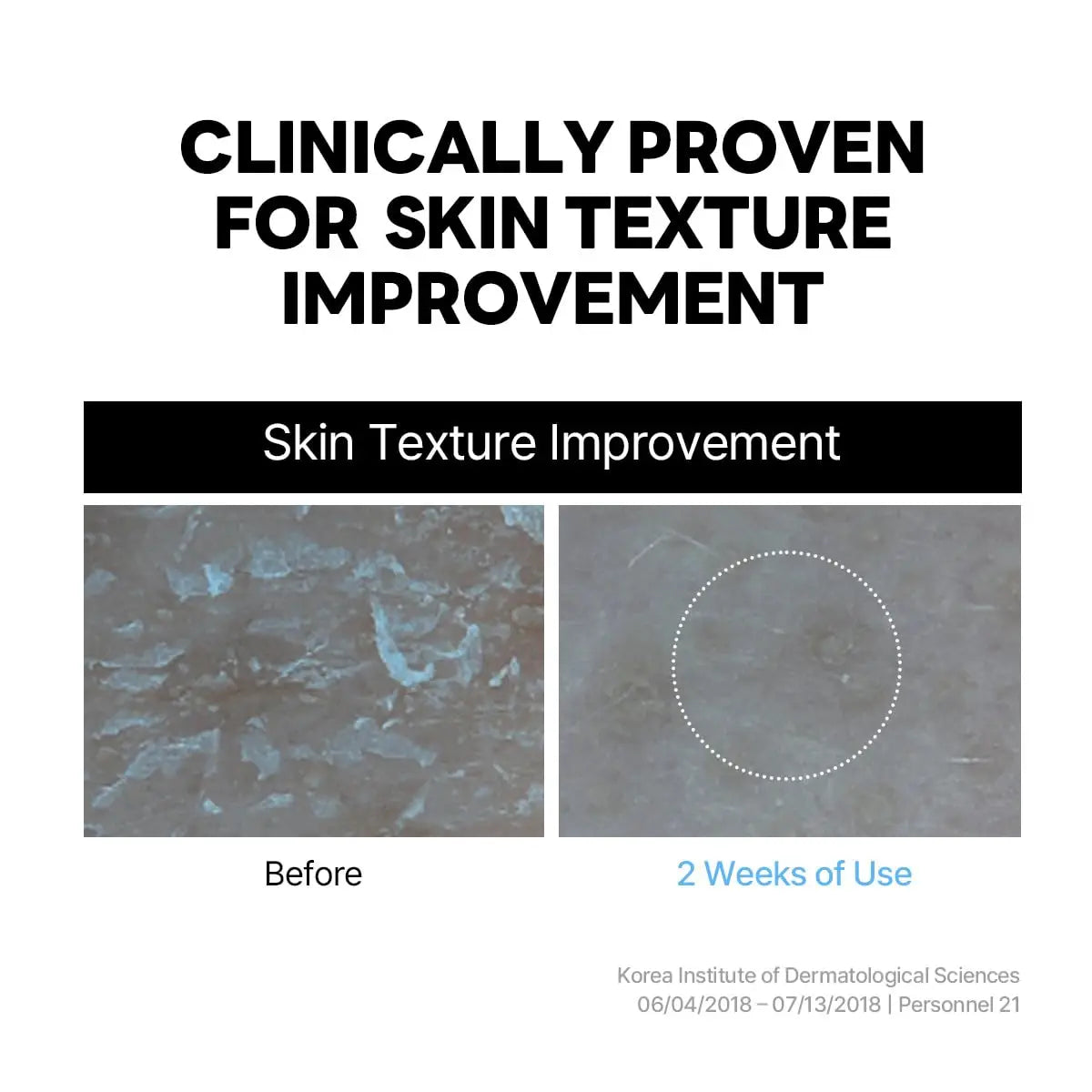 Clinical comparison showing skin texture improvement before and after 2 weeks of use with ROUND LAB 1025 DOKDO CREAM 80ml, demonstrating smoother skin surface.